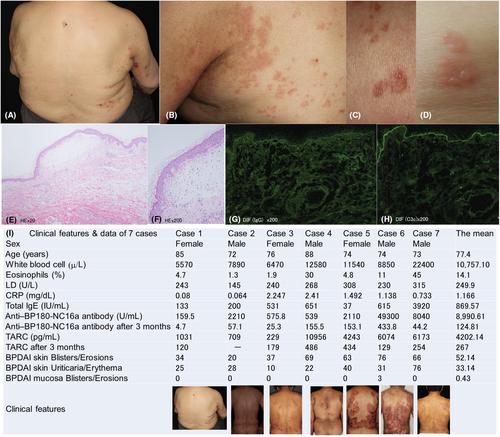 A case of bullous pemphigoid with correlation to serum levels of anti-BP180-NC16a antibodies and thymus and activation-regulated chemokine