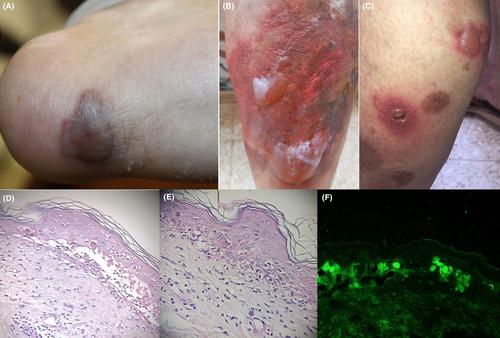 Atypical subepidermal blistering disease following COVID-19 vaccination