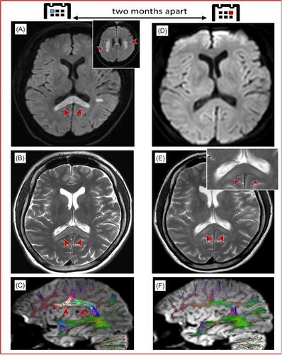 Stroke-like presentation of acute toxic leukoencephalopathy due to capecitabine treatment with extensive intramyelinic edema