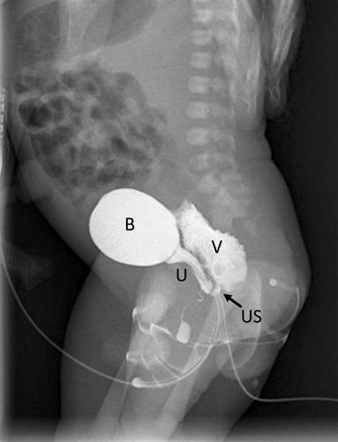 Perinatal diagnosis of congenital urogenital sinus abnormality