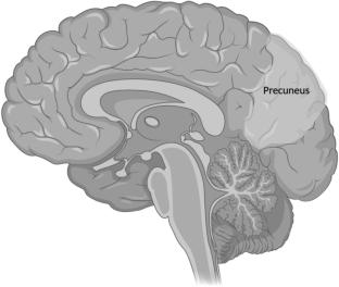 Clinical anatomy of the precuneus and pathogenesis of the schizophrenia