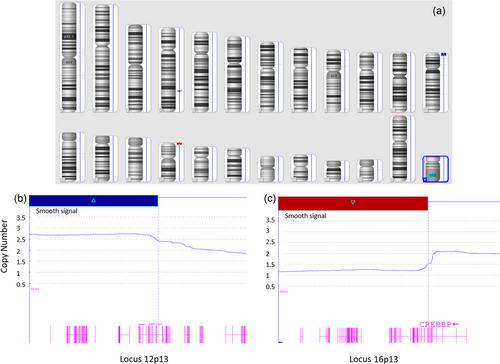 Added value of molecular karyotype in childhood acute lymphoblastic leukemia