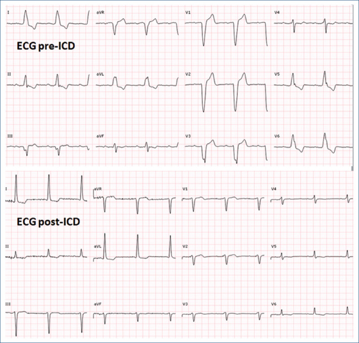 [Better late than never: assessment of arrhythmogenic cardiomyopathy in an elderly patient].