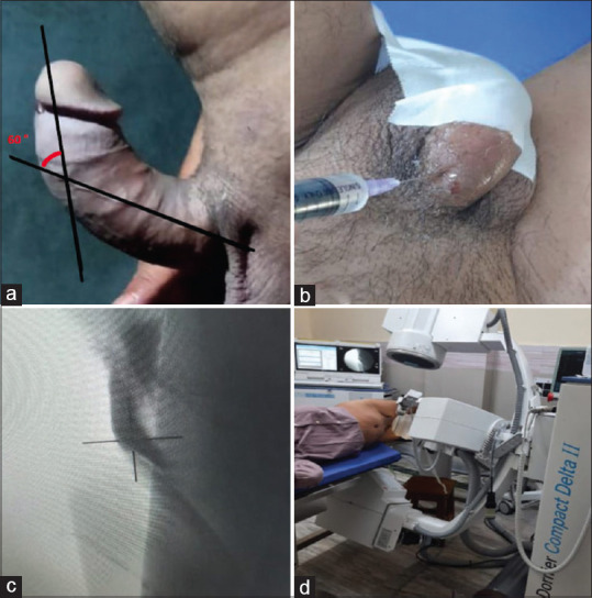 Low-intensity extracorporeal shockwave therapy for Peyronie's disease: An Indian experience.