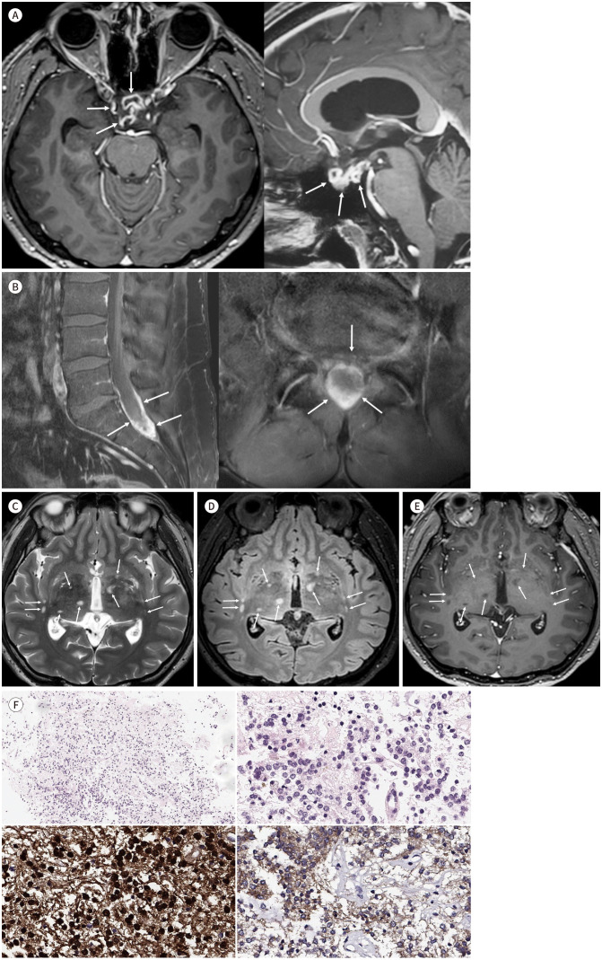 Diffuse Leptomeningeal Glioneuronal Tumor with FGFR1 Mutation in a 29-Year-Old Male.