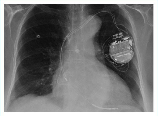 [Better late than never: assessment of arrhythmogenic cardiomyopathy in an elderly patient].