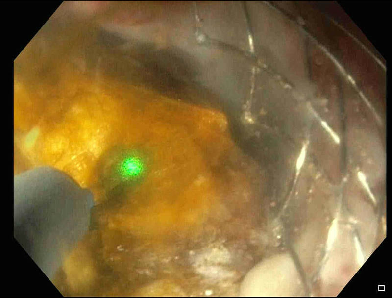 Endoscopic treatment of a giant stone in a patient with acute cholecystitis at a high surgical risk: breaking the paradigm (with videos).