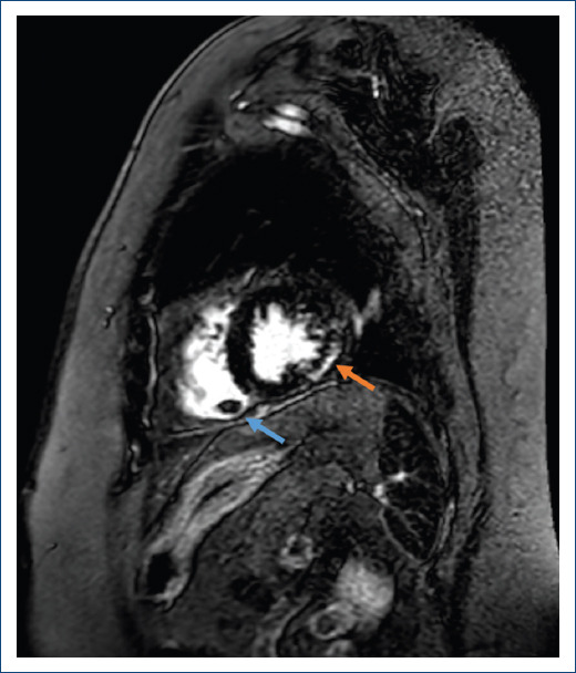 [Better late than never: assessment of arrhythmogenic cardiomyopathy in an elderly patient].