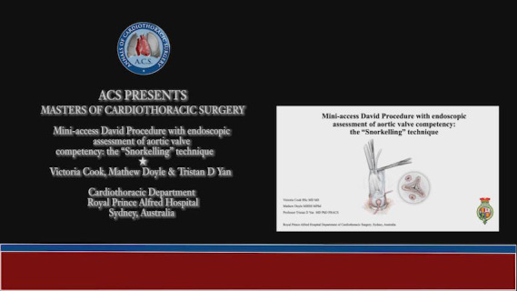 Mini-access David Procedure with endoscopic assessment of aortic valve competency: the "Snorkelling" technique.