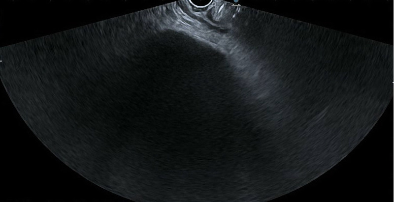 Endoscopic treatment of a giant stone in a patient with acute cholecystitis at a high surgical risk: breaking the paradigm (with videos).