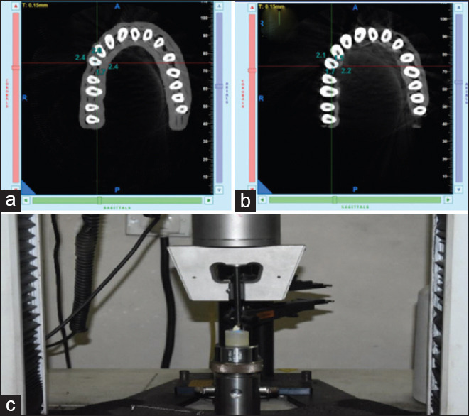 Comparative evaluation of pericervical dentin preservation and fracture resistance of root canal-treated teeth with rotary endodontic file systems of different types of taper - An <i>in vitro</i> study.