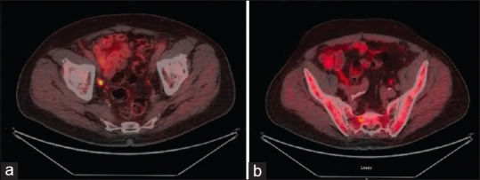 Traditional and novel imaging modalities for advanced prostate cancer: A critical review.