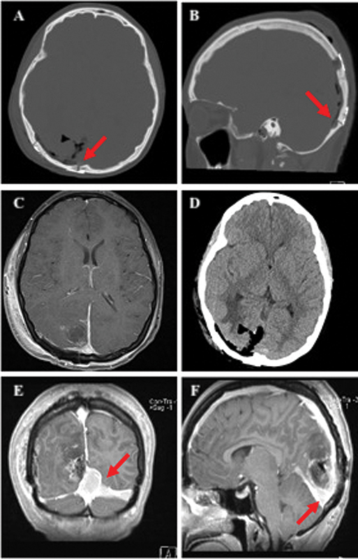 Surgical Management of Meningiomas Involving the Torcula, Transverse Sinus, and Jugular Bulb: A Technical Note and Review of the Literature.