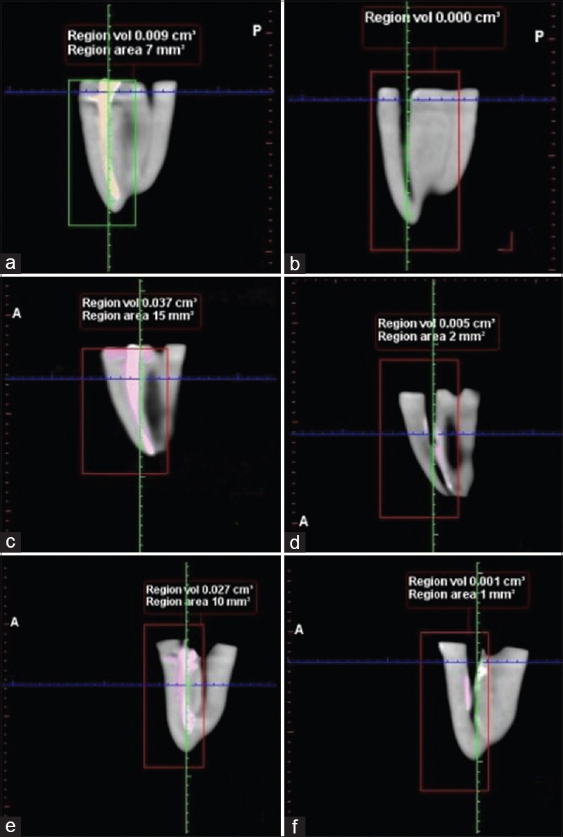 Evaluation of the efficacy of TruNatomy, ProTaper retreatment, and RaCe file systems in retreatment of moderately curved mandibular molars: An <i>in vitro</i> study.