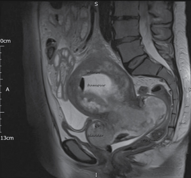 First Presentation and Diagnosis of a Rare Advanced Gynaecological Cancer in Emergency Department: A Case Report.