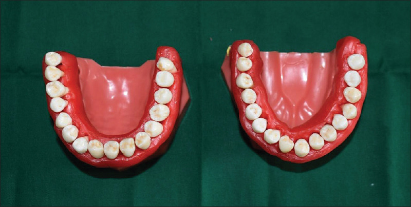 Comparative evaluation of pericervical dentin preservation and fracture resistance of root canal-treated teeth with rotary endodontic file systems of different types of taper - An <i>in vitro</i> study.