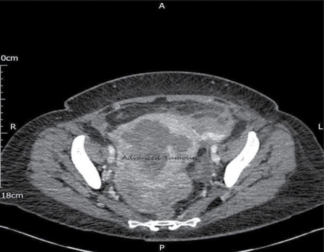 First Presentation and Diagnosis of a Rare Advanced Gynaecological Cancer in Emergency Department: A Case Report.