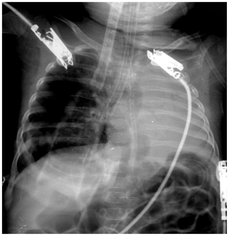 Infant Botulism.