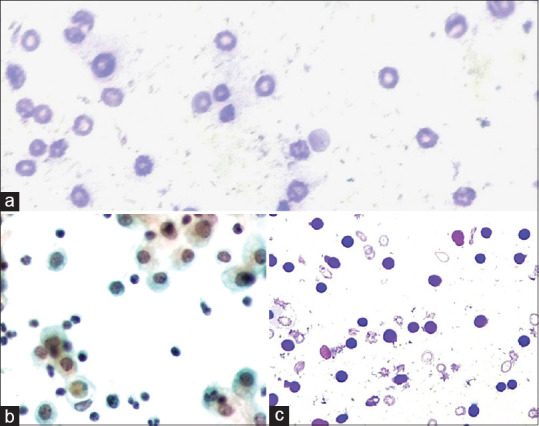 The Role of Novel Tiered Reporting System in Serous Fluid Cytology and Risk of Malignancy Assessment: A Retrospective Study in a Tertiary Care Center.