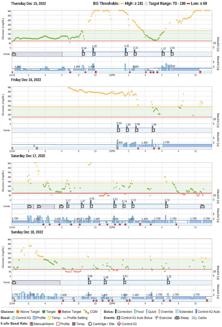 Diabetic Ketoacidosis in a Patient With Type I Diabetes Treated With a Closed-Loop Sensor–Augmented Insulin Infusion System