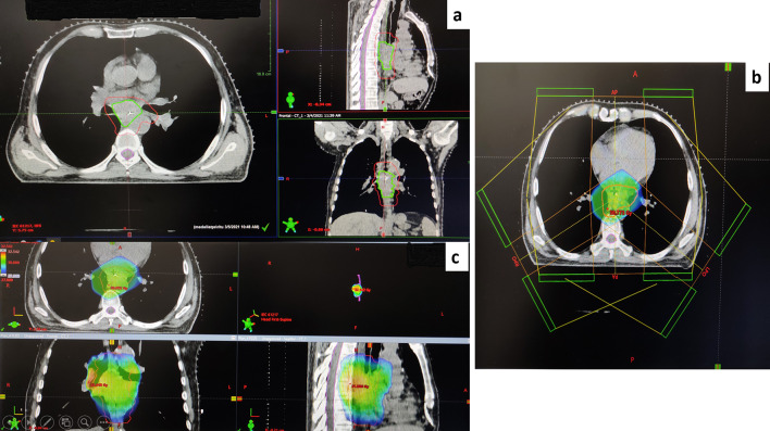 Abscopal effect of radiation in metastatic esophageal carcinoma: fourth reported case.