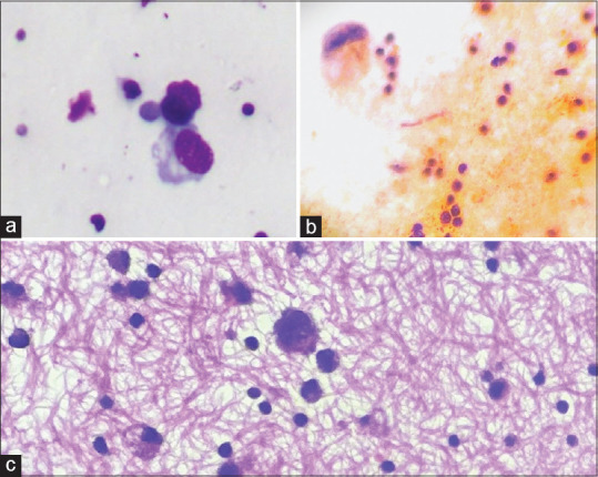 The Role of Novel Tiered Reporting System in Serous Fluid Cytology and Risk of Malignancy Assessment: A Retrospective Study in a Tertiary Care Center.