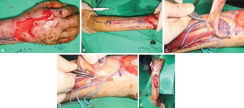 Reconstruction of Hand Dorsum Defect Using Double Perforators-Based Anterior Interosseous Artery Island Flap: A Case Report and Description of a New Anterior Interosseous Artery Perforator.