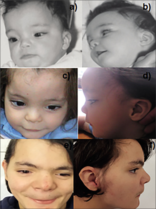 Features of the Wolf-Hirschhorn Syndrome (WHS) from Infant to Young Teenager.