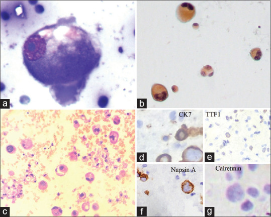 The Role of Novel Tiered Reporting System in Serous Fluid Cytology and Risk of Malignancy Assessment: A Retrospective Study in a Tertiary Care Center.