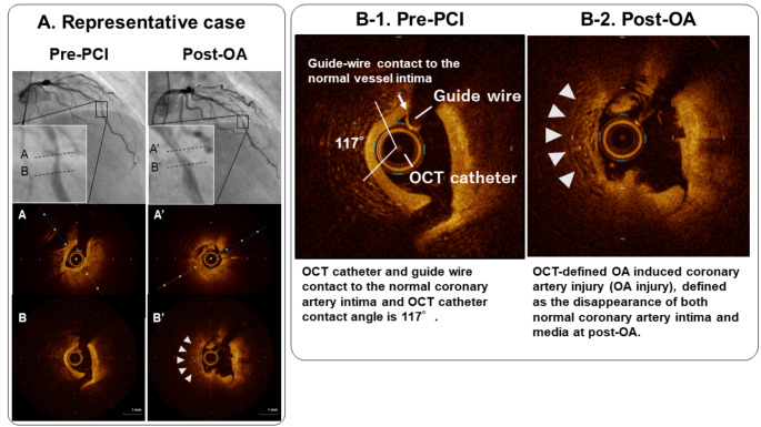 Predictors of coronary artery injury after orbital atherectomy as assessed by optical coherence tomography.