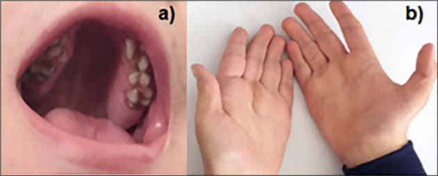 Features of the Wolf-Hirschhorn Syndrome (WHS) from Infant to Young Teenager.