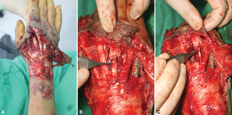 Reconstruction of Hand Dorsum Defect Using Double Perforators-Based Anterior Interosseous Artery Island Flap: A Case Report and Description of a New Anterior Interosseous Artery Perforator.