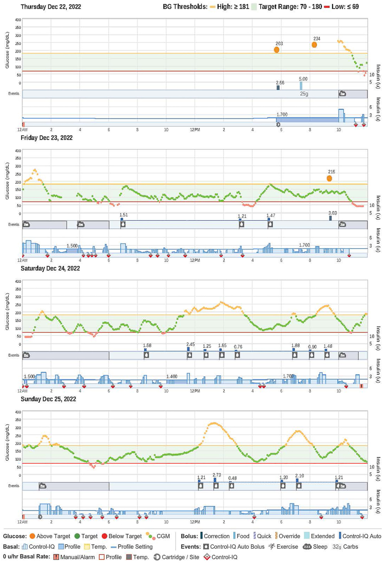 Diabetic Ketoacidosis in a Patient With Type I Diabetes Treated With a Closed-Loop Sensor–Augmented Insulin Infusion System