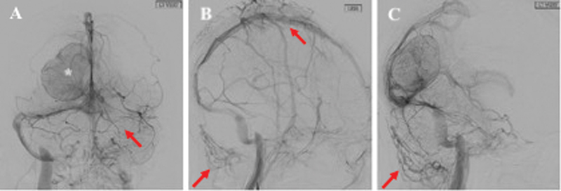 Surgical Management of Meningiomas Involving the Torcula, Transverse Sinus, and Jugular Bulb: A Technical Note and Review of the Literature.