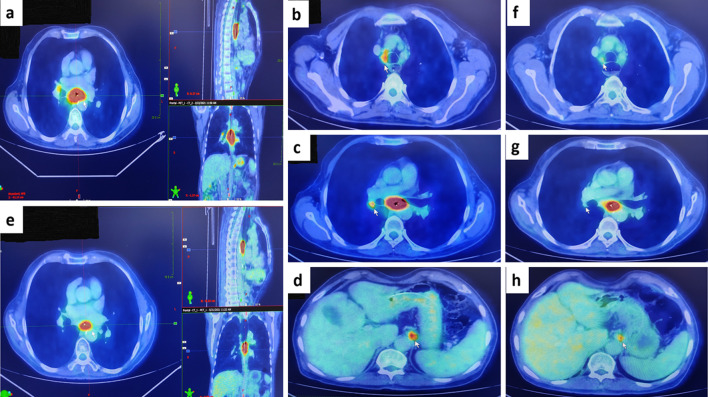 Abscopal effect of radiation in metastatic esophageal carcinoma: fourth reported case.