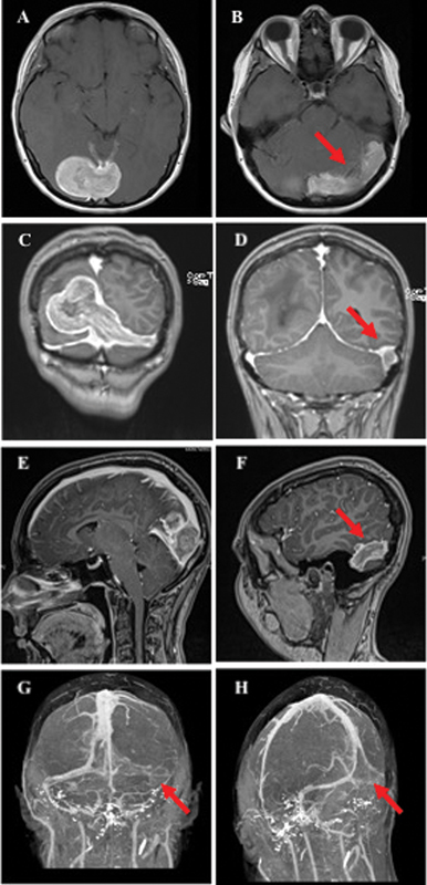 Surgical Management of Meningiomas Involving the Torcula, Transverse Sinus, and Jugular Bulb: A Technical Note and Review of the Literature.