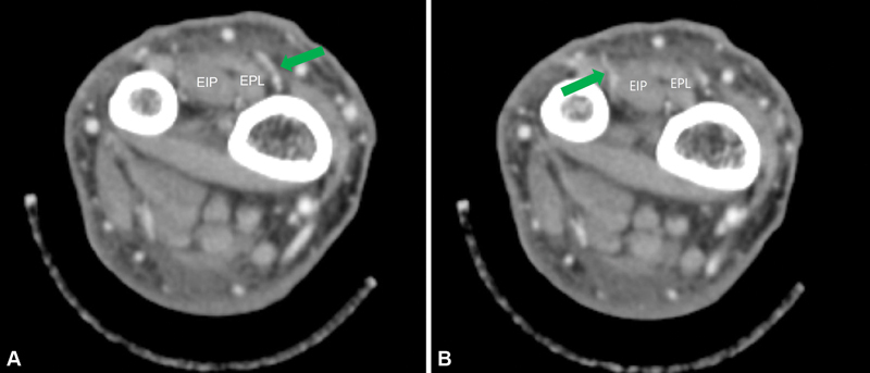 Reconstruction of Hand Dorsum Defect Using Double Perforators-Based Anterior Interosseous Artery Island Flap: A Case Report and Description of a New Anterior Interosseous Artery Perforator.