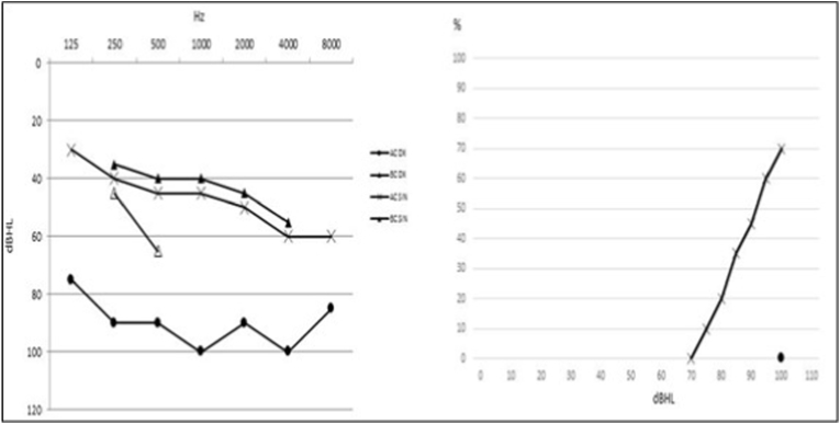 The role of cochlear implantation in alleviating Tumarkin drop attacks of Meniere's disease; a case report