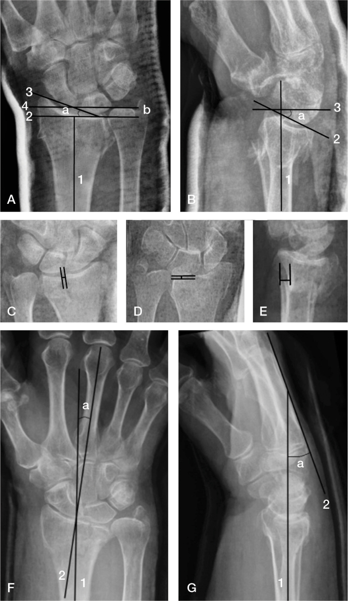 Intra- and inter-observer agreement in distal radius fracture dislocation measurement of casting position.