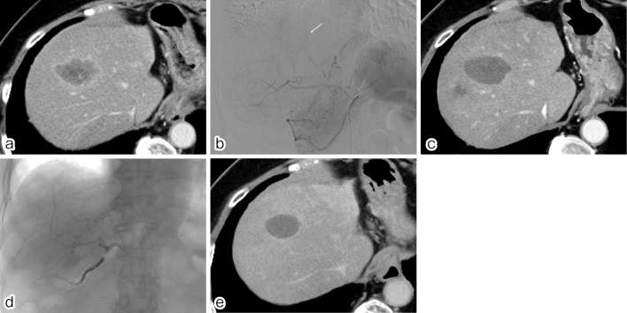 Transarterial Chemoembolization with Irinotecan-loaded Beads Followed by Arterial Infusion of 5-Fluorouracil for Metastatic Liver Tumors Refractory to Standard Systemic Chemotherapy.