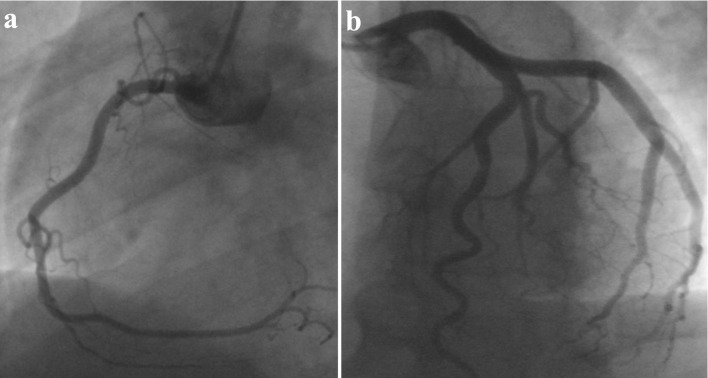 Myocarditis Related to the Use of Mesalazine.