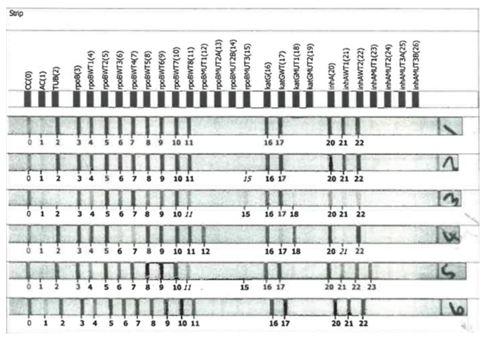 The Detection of Mutations and Genotyping of Drug-Resistant <i>Mycobacterium tuberculosis</i> Strains Isolated from Patients in the Rural Eastern Cape Province.