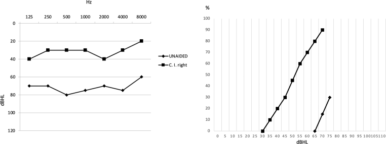 The role of cochlear implantation in alleviating Tumarkin drop attacks of Meniere's disease; a case report