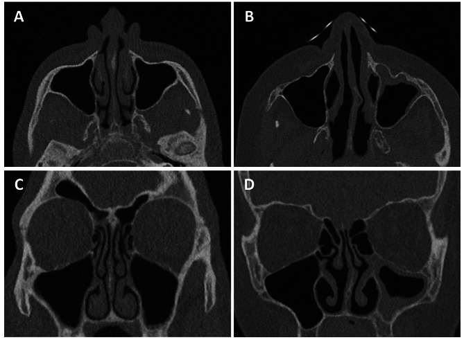 Dose development in sinonasal imaging over the last decade - a retrospective patient study.