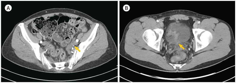 Usefulness of Corticomedullary-Phase CT Urography in Patients with Suspected Acute Renal Colic Visiting the Emergency Department.