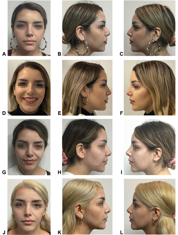 Lipoinjection with Adipose Stem Cells for Nasal Modeling: Rhino Cell, a Highly Versatile Alternative.