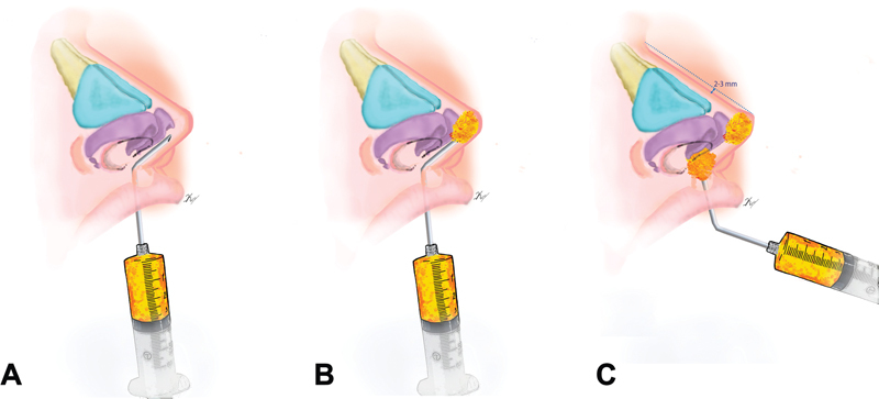 Lipoinjection with Adipose Stem Cells for Nasal Modeling: Rhino Cell, a Highly Versatile Alternative.