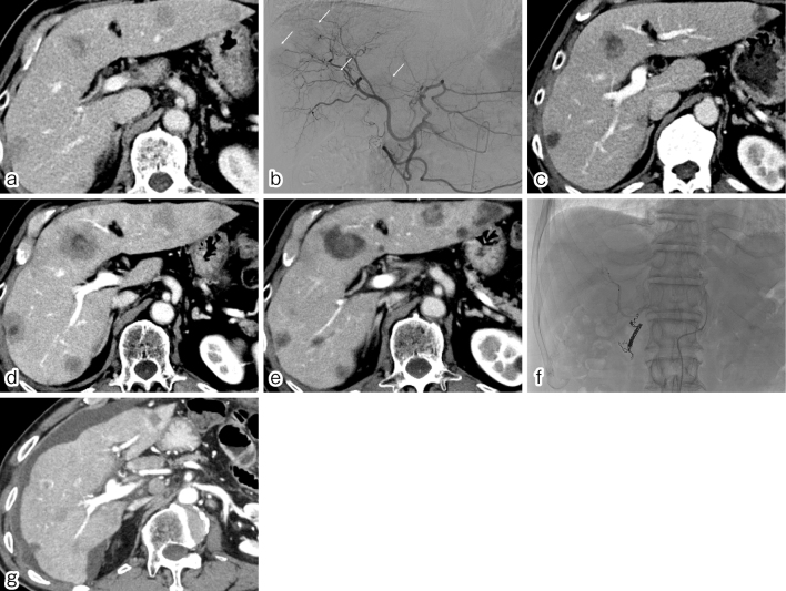 Transarterial Chemoembolization with Irinotecan-loaded Beads Followed by Arterial Infusion of 5-Fluorouracil for Metastatic Liver Tumors Refractory to Standard Systemic Chemotherapy.