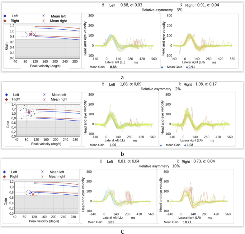 The role of cochlear implantation in alleviating Tumarkin drop attacks of Meniere's disease; a case report