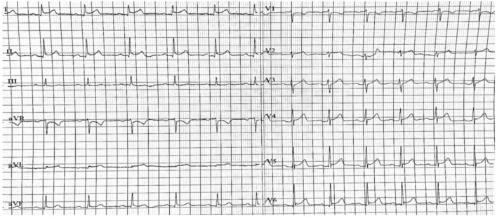 Myocarditis Related to the Use of Mesalazine.